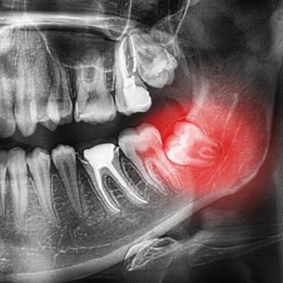 Impacted Wisdom Teeth Thornhill
