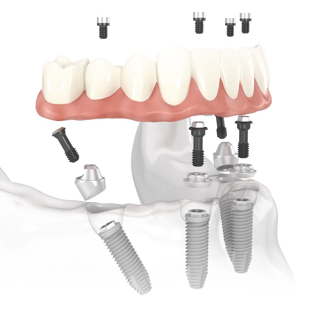 All on 4 Implants Cross Section