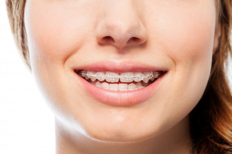 Traditional Braces in Thornhill
