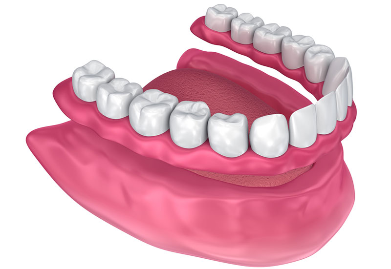 Full Partial Denture