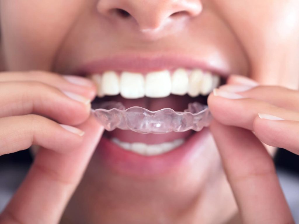 Invisalign in Thornhill