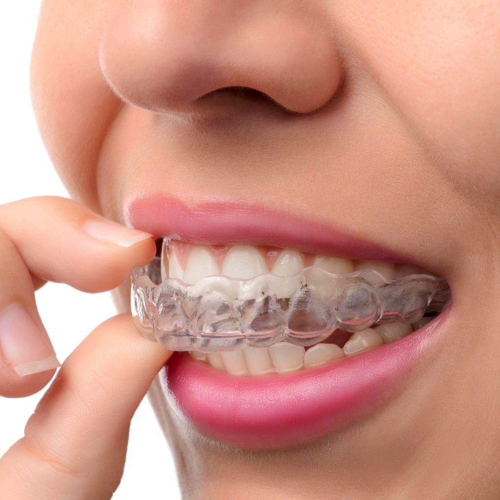 Invisalign in Thornhill