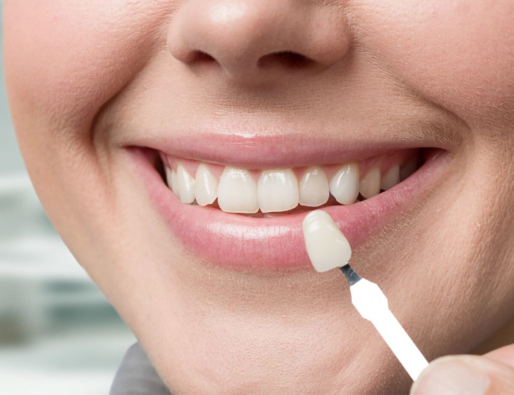 Porcelain Veneers in Thornhill