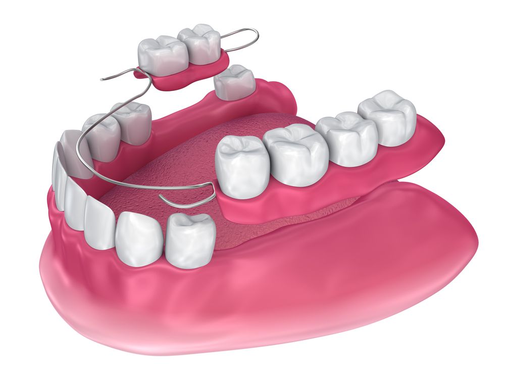Removable Partial Dentures