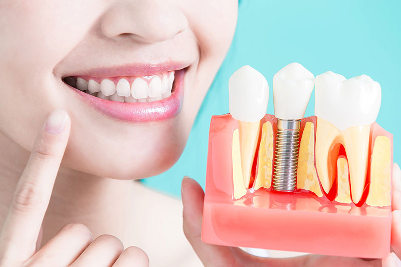 Root Canal Treatment Cross Section