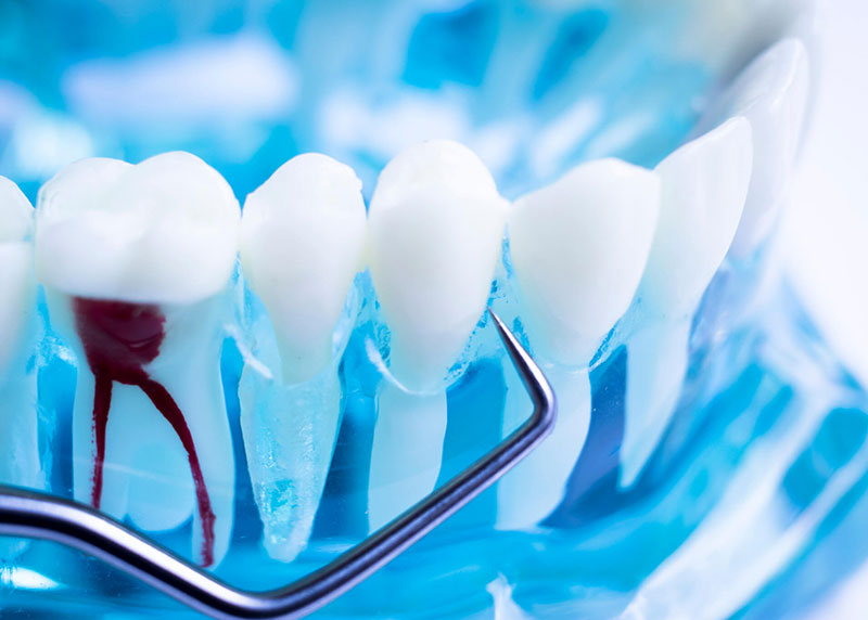 Root Canal Treatment Closeup