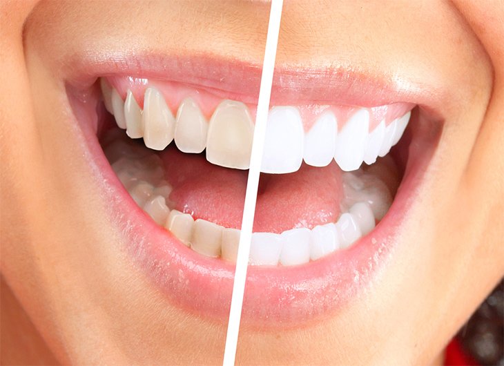 Teeth Whitening in Thornhill