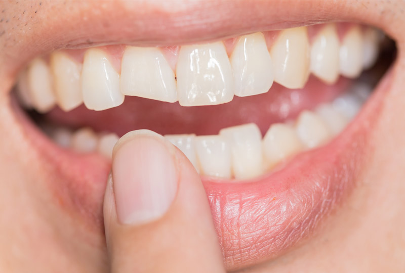 Dental Trauma