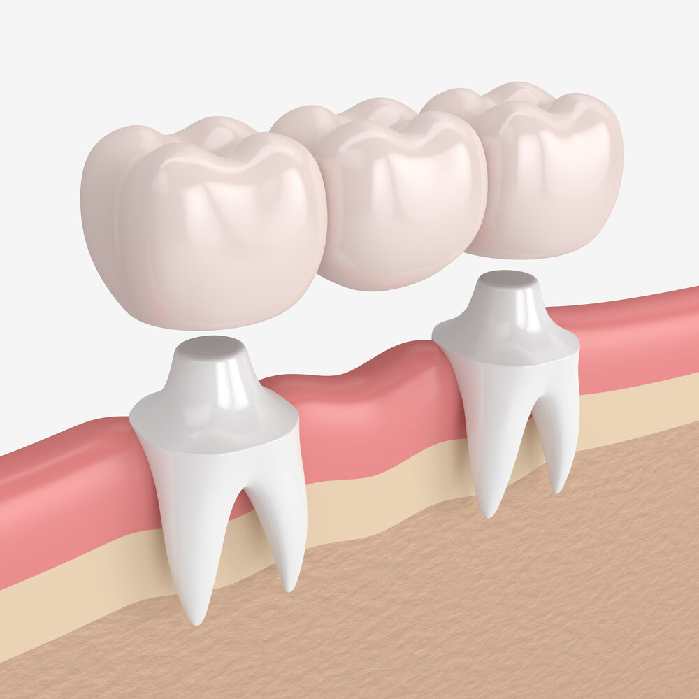 Dental Crowns and Bridges in Thornhill