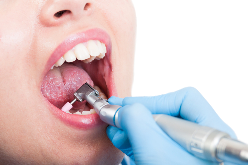 Tooth Polishing and Scaling